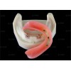 种植覆盖义齿，适用于无牙颌患者的修复治疗