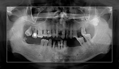 严重的牙周炎X光片