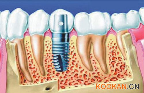 种植牙示意图