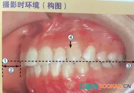 拍不好口腔照片怎么办？这些口腔摄影方法与技巧请收好！