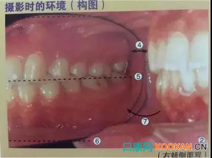 拍不好口腔照片怎么办？这些口腔摄影方法与技巧请收好！