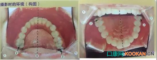 拍不好口腔照片怎么办？这些口腔摄影方法与技巧请收好！